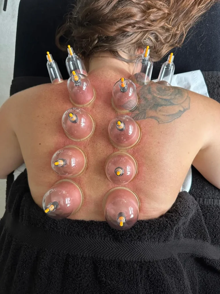 Cupping 1