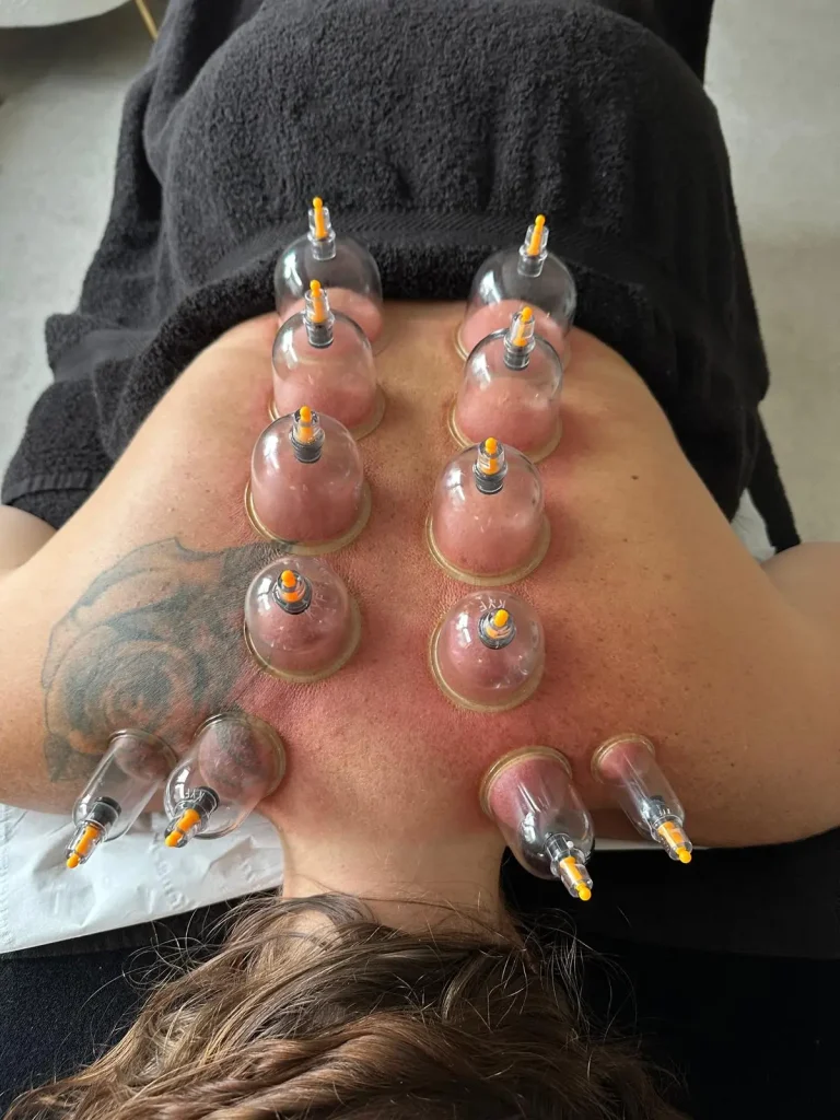 Cupping 2