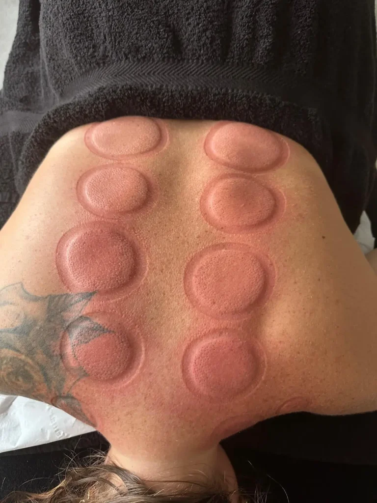 Cupping Forever Balanced Therapy