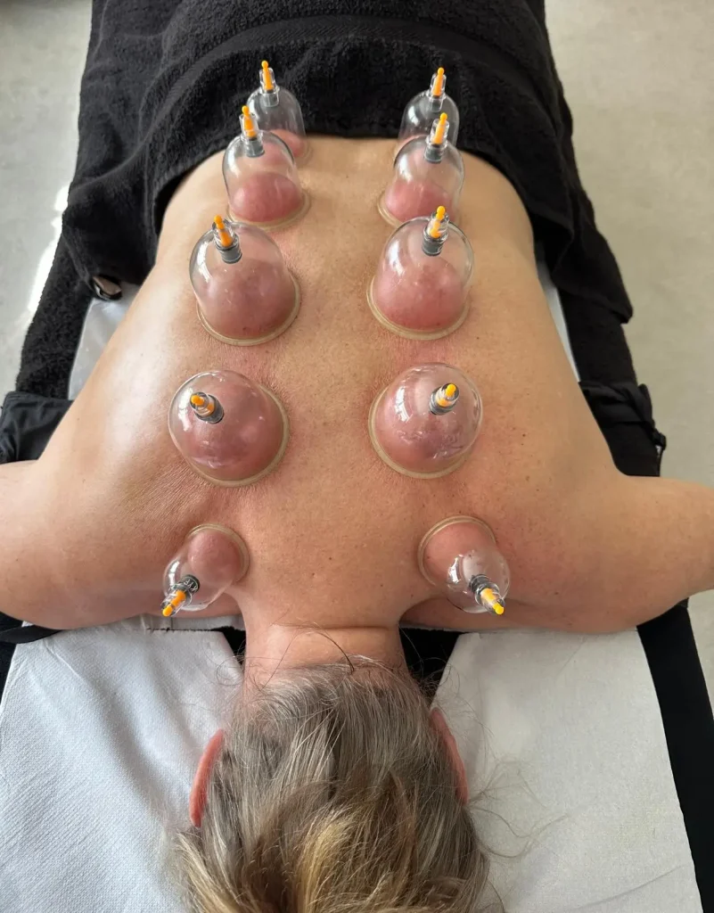Cupping Images