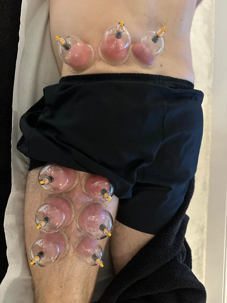 Cupping Therapy